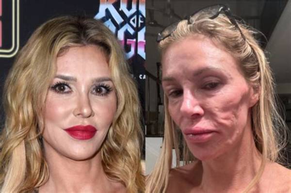 Brandi Glanville Previously Explained Why Her Mouth Looks a Little Wonky