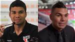 Casemiro Surgery | Nose Job Before and After Photos