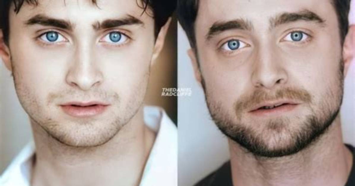 Daniel Radcliffe Nose Job: Before and After Photos