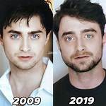 Daniel Radcliffe Nose Job: Before and After Photos