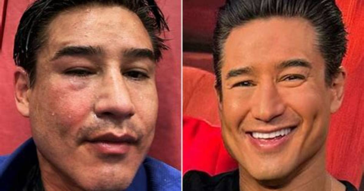 Did Mario Lopez Get a Face Lift Surgery?