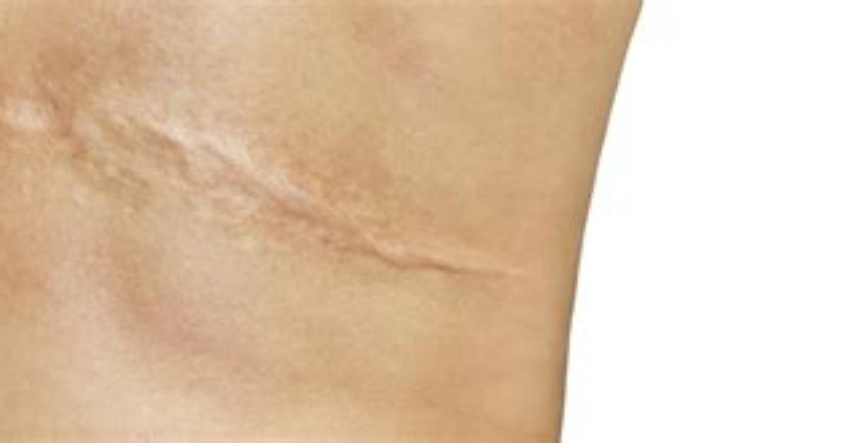 Does She Have a Scar? Surgery and Health Update