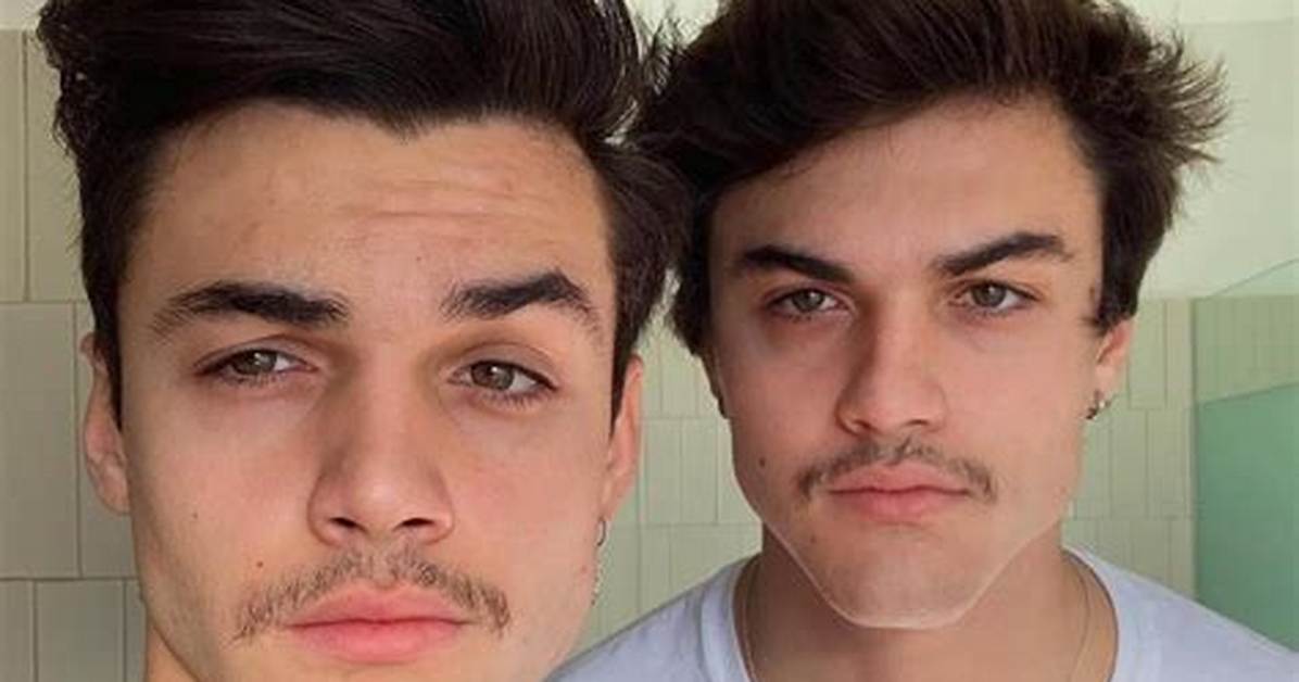 Fans Think That the Dolan Twins Got Matching Nose Jobs After Recent "Sinus Surgery"