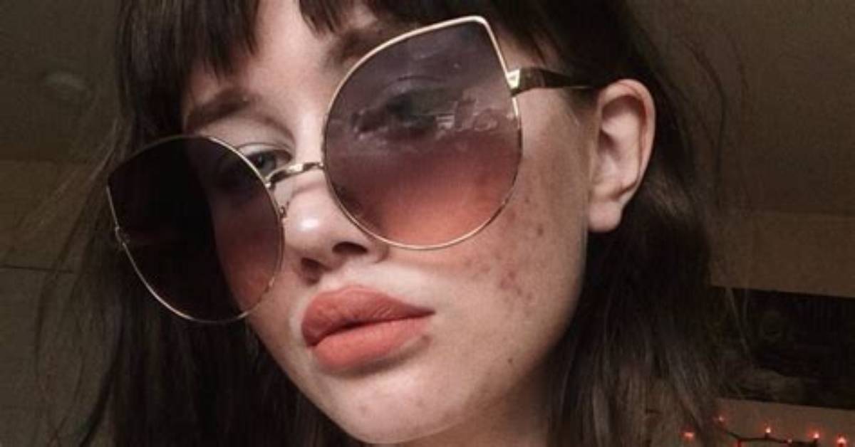 Girl with Cystic Acne Is Getting Rid of 'Pimple Stigma' by Going Makeup Free