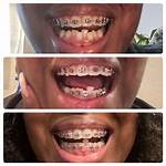 Has He Used Braces? Health Update