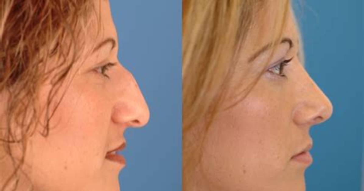 Ice Poseidon Nose Surgery | Before and After Photos