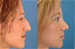 Ice Poseidon Nose Surgery | Before and After Photos