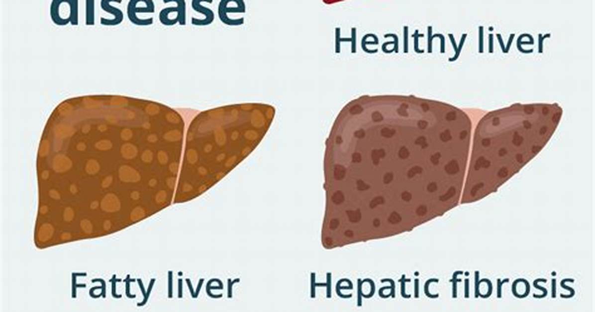 Is Edp445 Dying from Liver Failure?