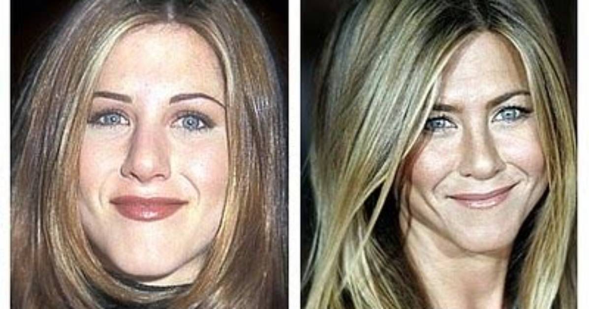 Jennifer Aniston Nose Job | Botox and Lip Filler Before and After Photos
