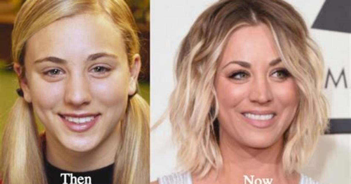 Kaley Cuoco Botox: Before and After Photos