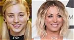 Kaley Cuoco Botox: Before and After Photos