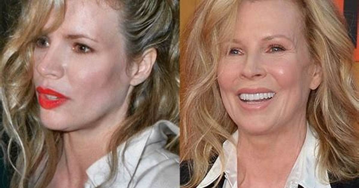 Kim Basinger Plastic Surgery Before and After- Health Update
