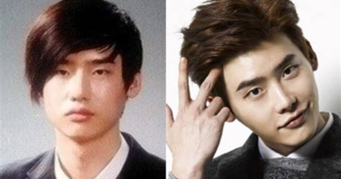 Lee Jong Suk | Before Plastic Surgery? Wrong with His Face?