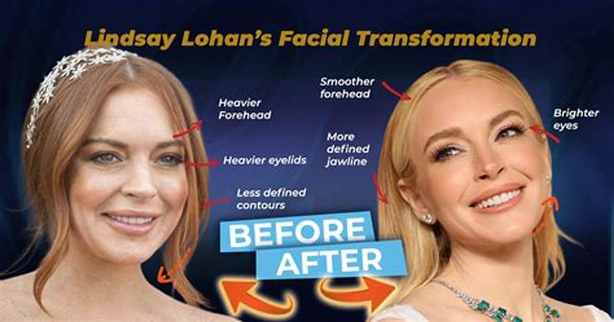 Lindsay Lohan Face Lift and Nose Job | Before and After Photos