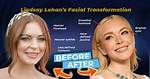 Lindsay Lohan Face Lift and Nose Job | Before and After Photos
