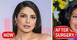 Priyanka Chopra Says a Botched Medical Procedure Led to Several Corrective Cosmetic Surgeries