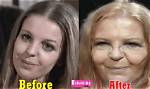 Sally Thomsett Face Surgery: Before and After Pictures