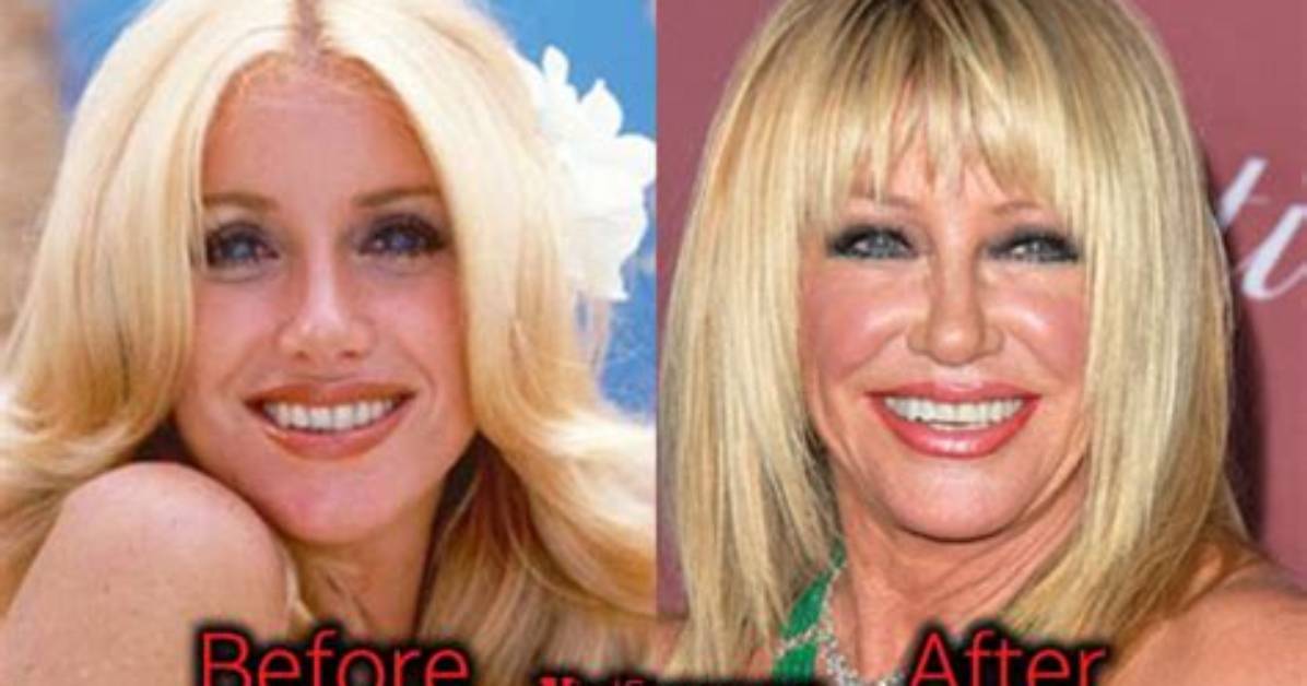 Suzanne Somers Plastic Surgery and Face Lift Photo