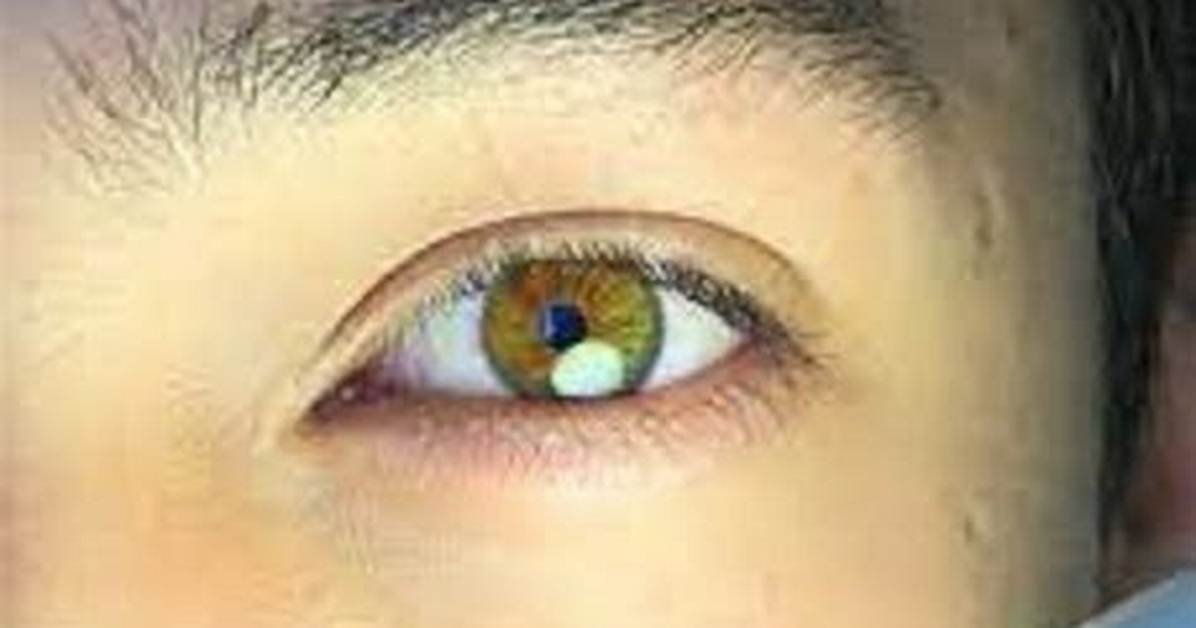 What Happened to Seth Fedelin Eyes | Is He Suffering from Disease